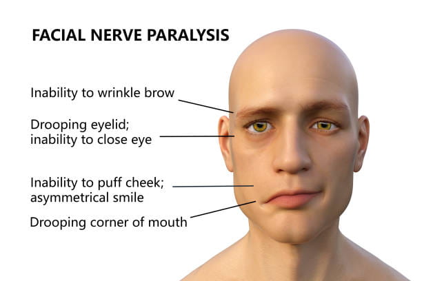 bell's palsy treatment in Langley