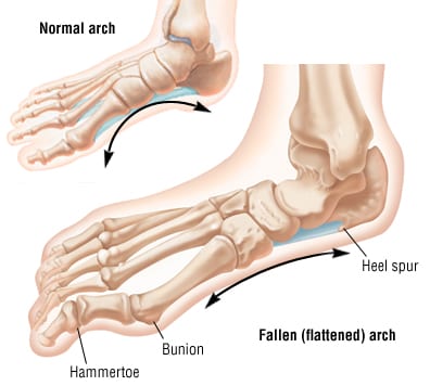 flat foot planus